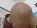 Hygroma.