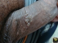 Herpes.