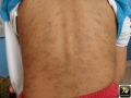 Hyperpigmentation post inflammatoire.