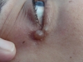 Hydradenome