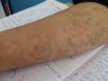 hyperpigmentation-post-herpes-gestationis
