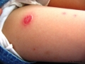 Impetigo.