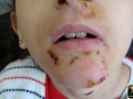 Impetigo.