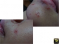 Impetigo.