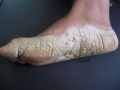 Keratodermie plantaire.