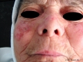 Keratose actinique.
