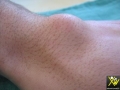 Kyste synovial.