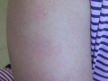 Keratose pilaire.