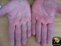 Keratodermie unilaterale dermatophytique.