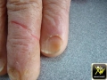 Koilonychie sur eczema des mains.