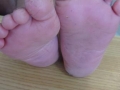 keratodermie plantaire juvenile.