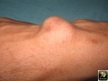 Kyste synovial.