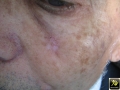 Keratose actinique.