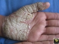 Keratodermie .