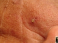 Keratose actinique.