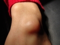 kyste-synovial-250518-1-min