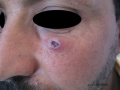 Leishmaniose.