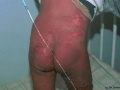 Lyell staphylococcique, syndrome de.
