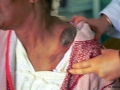 Lymphome malin non hodgkinien.