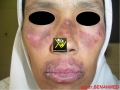 Lupus erythemateux chronique.