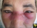 Lupus erythemateux disseminé.