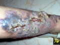 Lymphangiome.