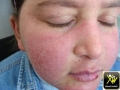 Lupus erythemateux aigu disseminé.