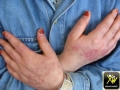 Lupus erythemateux aigu disseminé.