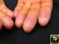 Lupus erythemateux aigu disseminé.