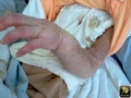 Lymphangite carcinomateuse.