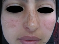 Melasma.