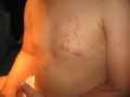 Molluscum contagiosum.