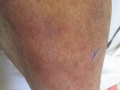 Mycosis fongoide.