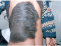 Naevus congenital géant.