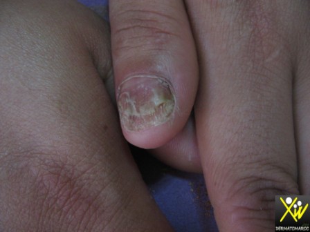 Psoriasis des ongles.