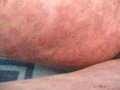 Pemphigus.