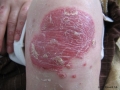Psoriasis.