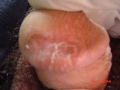 Psoriasis .