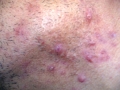 Pustulose de la barbe.