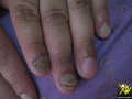 Psoriasis des ongles.