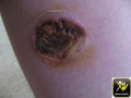 Pyoderma gangrenosum.