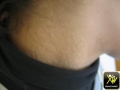 Pseudoxanthome élastique.