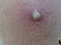Pustule.