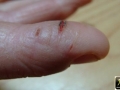 Pulpite fissuraire, eczema.