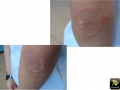 Psoriasis annulaire.