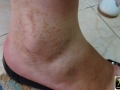 Purpura.