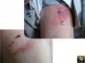 Pemphigus.
