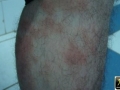 Parapsoriasis .