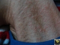 Pseudoxanthome élastique.