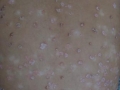 Psoriasis en gouttes.